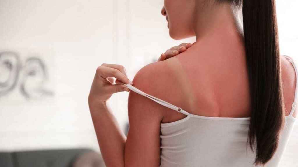 Insolação como tratar: sintomas, cuidados e tratamentos eficazes Insolação como tratar