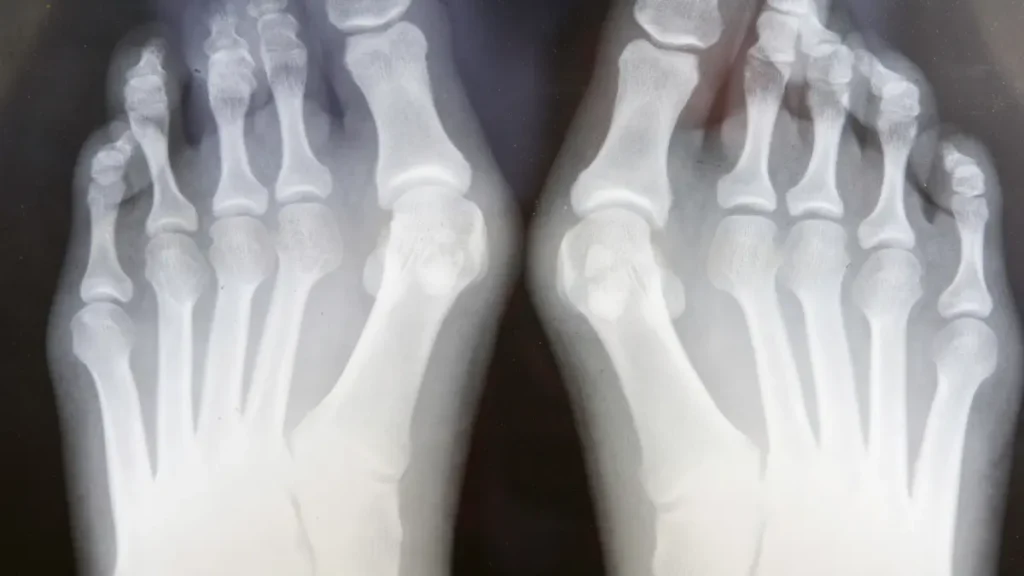 Quantos dias de atestado para cirurgia de joanete? Quantos dias de atestado para cirurgia de joanete